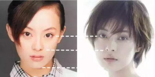 明星注射玻尿酸吗,揭秘美丽背后的秘密